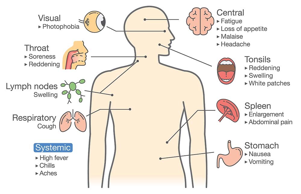 mononucleosis